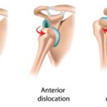 How to Relocate a Shoulder