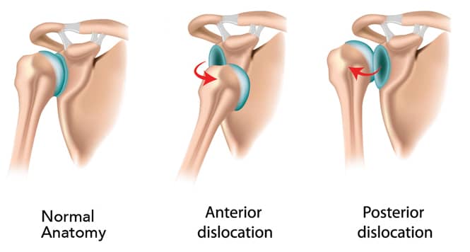 How to Relocate a Shoulder